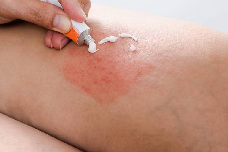 Kem bôi trị bệnh chàm