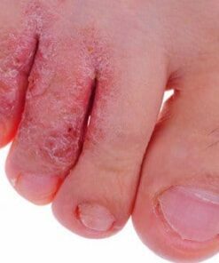 Sơn móng Ciclopirox 8% VCP 10ml điều trị nấm móng tay, nấm móng chân 6 ciclopirox gel 0 77 dieu tri nam da hac lao lang ben viem da tiet ba nam candida 1689