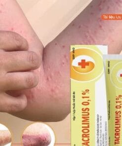 Tacrolimus 0.1% VCP 15g - Điều trị viêm da cơ địa, dị ứng da, chàm, vảy nến, eczema
