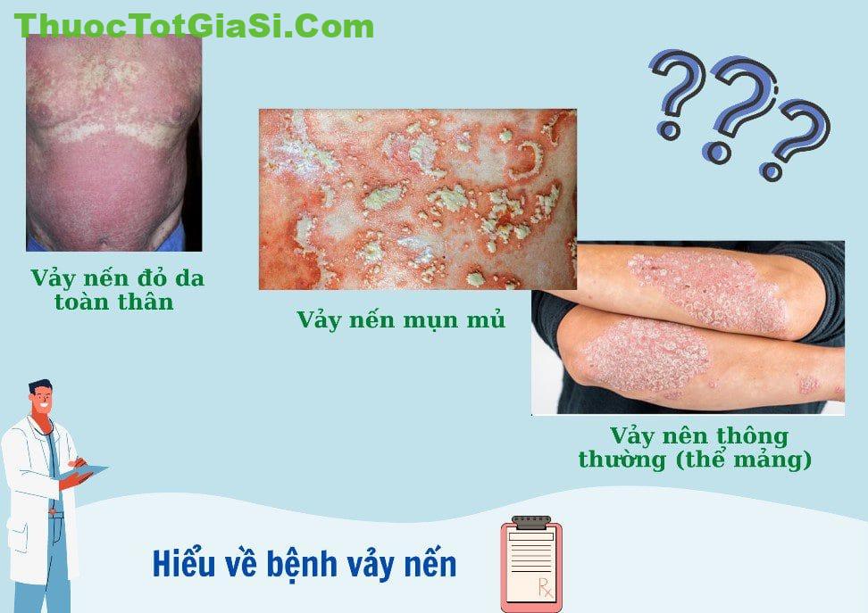 Bệnh vảy nến cần kiêng những gì? Bệnh vảy nến có chữa được không? Điều trị bệnh vảy nến? 1 benh vay nen can kieng nhung gi benh vay nen co chua duoc khong 2248