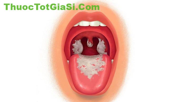 DỊCH BỆNH BẠCH HẦU NHỮNG ĐIỀU CẦN BIẾT 1 nguyen nhan trieu chung cach phong chong dich benh bach hau 2195 4