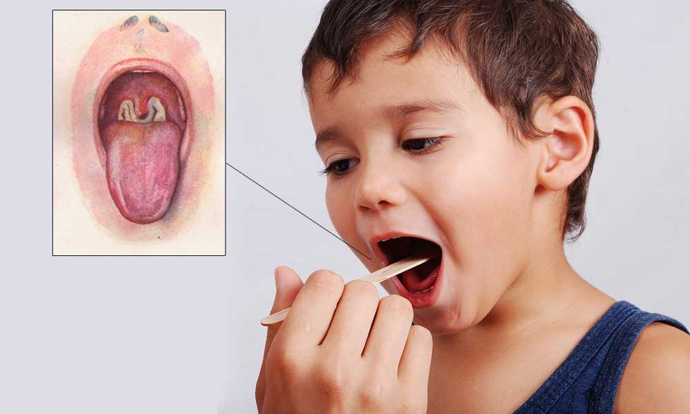 Đặc điểm, nguyên nhân, triệu chứng, đường lây truyền, cách phòng chống bệnh bạch hầu- Ảnh 6. Đặc điểm, nguyên nhân, triệu chứng, đường lây truyền, cách phòng chống bệnh bạch hầu- Ảnh 6.